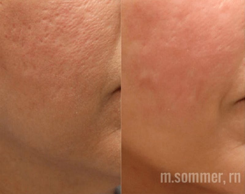 Pixel-8 RF Before & After Gallery - Patient 253481 - Image 3