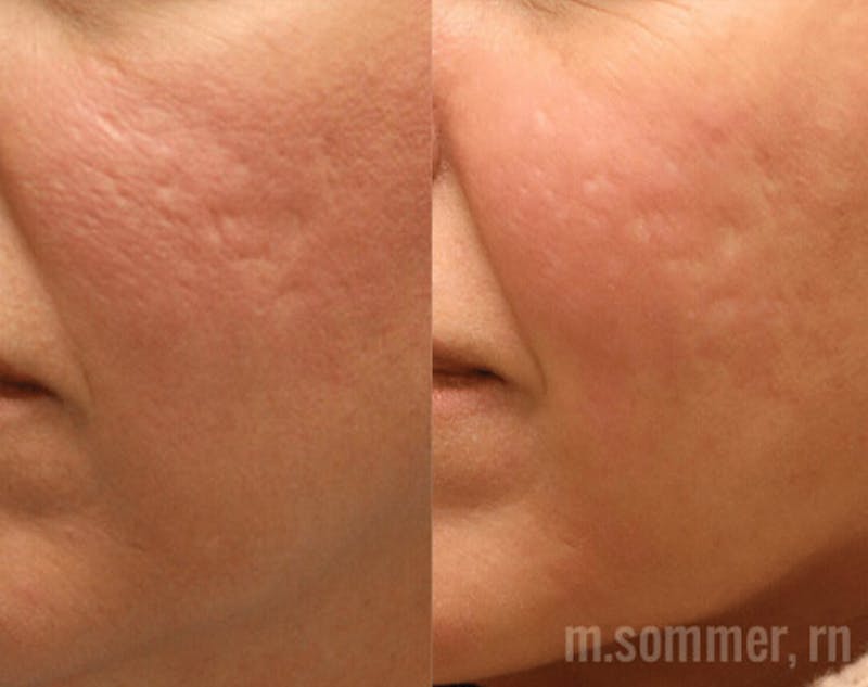 Pixel-8 RF Before & After Gallery - Patient 253481 - Image 4