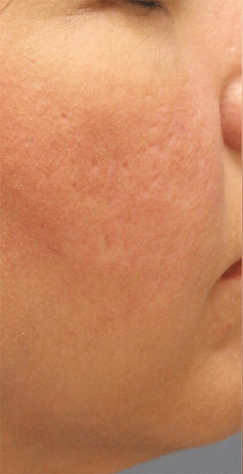 Pixel-8 RF Before & After Gallery - Patient 271763 - Image 1