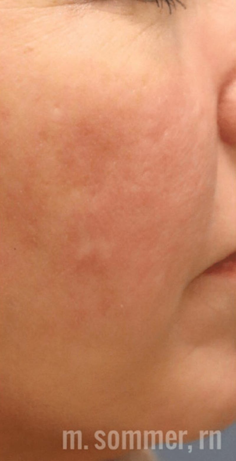 Pixel-8 RF Before & After Gallery - Patient 271763 - Image 2