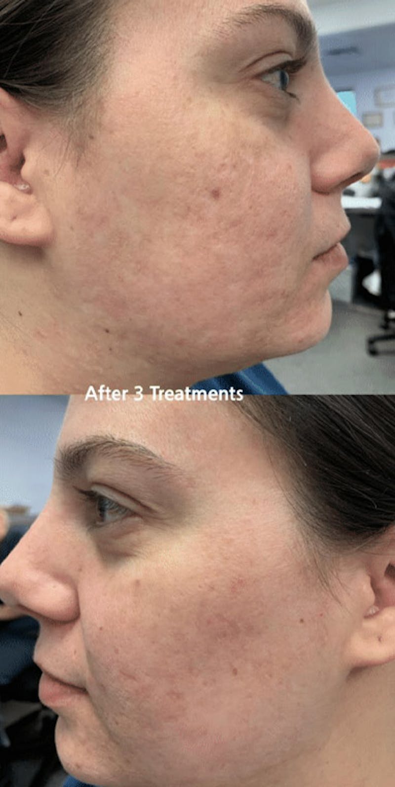 Pixel-8 RF Before & After Gallery - Patient 186911 - Image 2