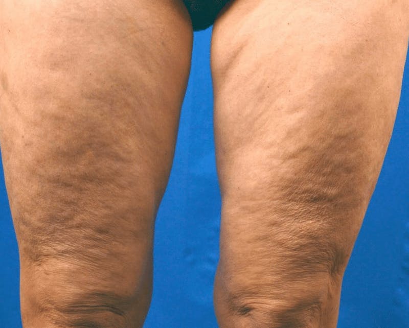 Pixel-8 RF Before & After Gallery - Patient 143055 - Image 1