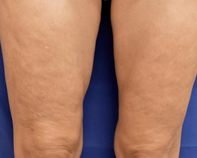 Pixel-8 RF Before & After Gallery - Patient 143055 - Image 2