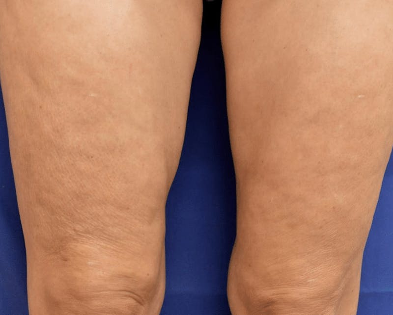 Pixel-8 RF Before & After Gallery - Patient 143055 - Image 2