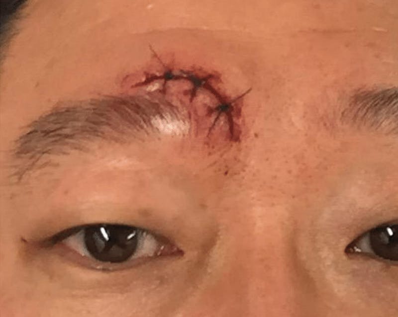 Pixel-8 RF Before & After Gallery - Patient 417475 - Image 1