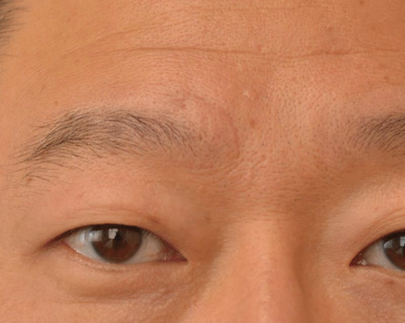 Pixel-8 RF Before & After Gallery - Patient 417475 - Image 2