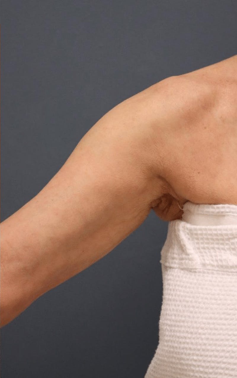 Pixel-8 RF Before & After Gallery - Patient 275752 - Image 2