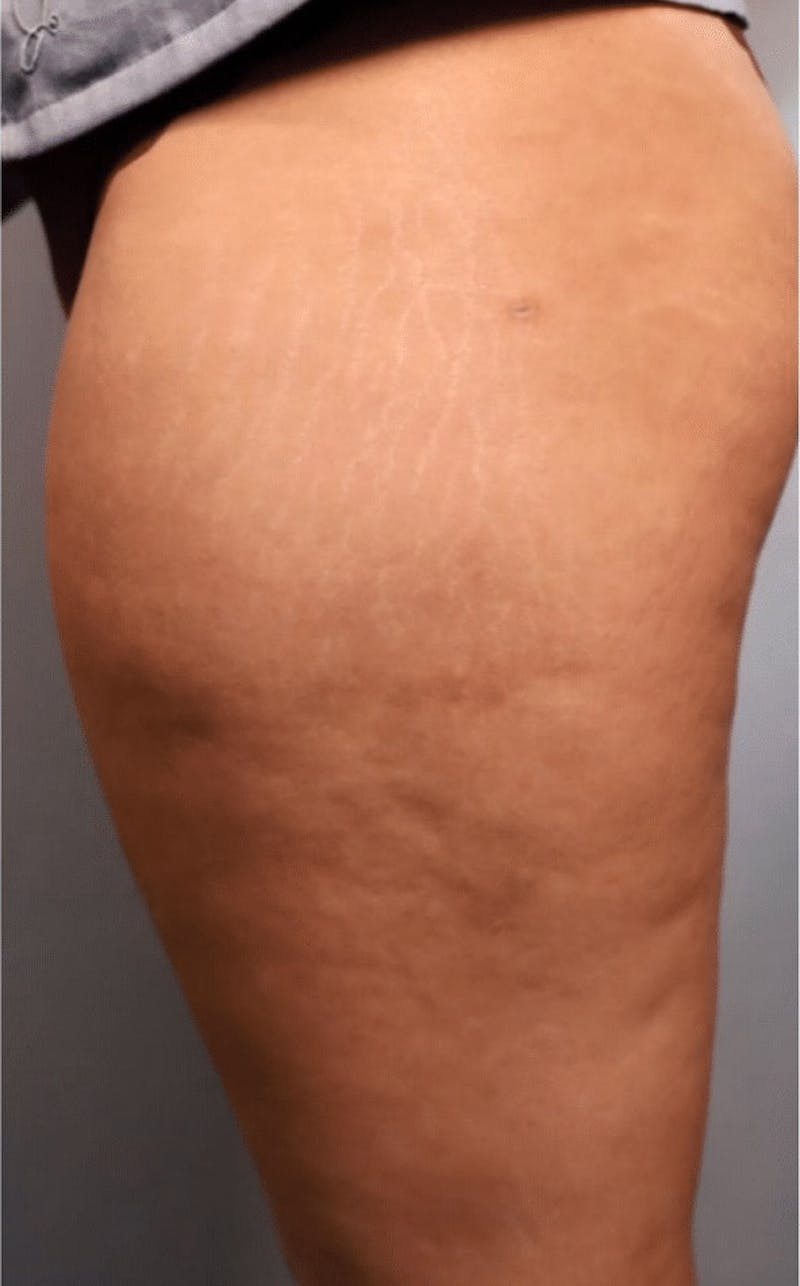 Pixel-8 RF Before & After Gallery - Patient 423786 - Image 1