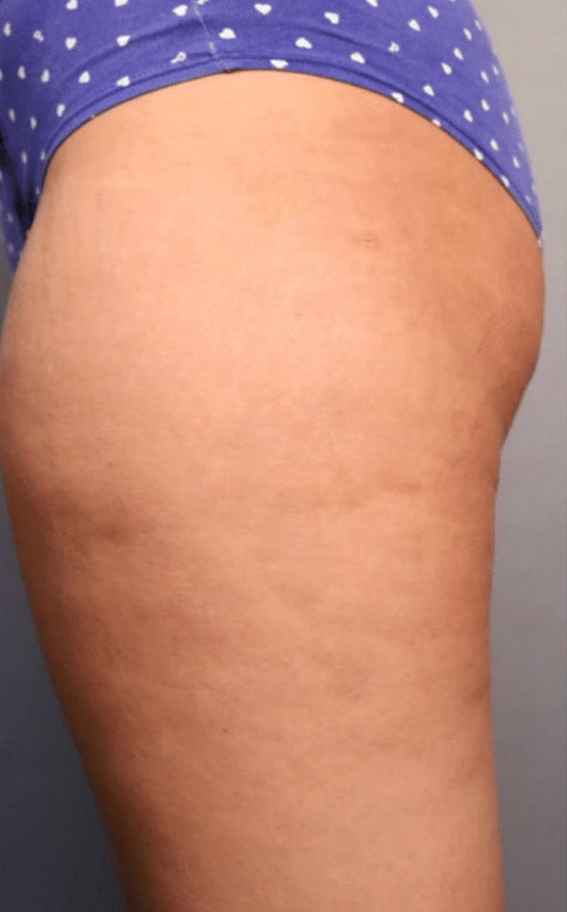 Pixel-8 RF Before & After Gallery - Patient 423786 - Image 2