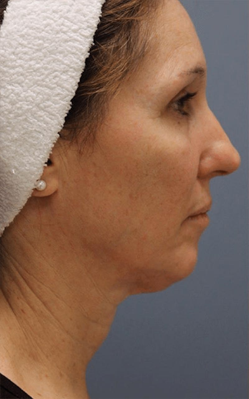 Pixel-8 RF Before & After Gallery - Patient 152226 - Image 1