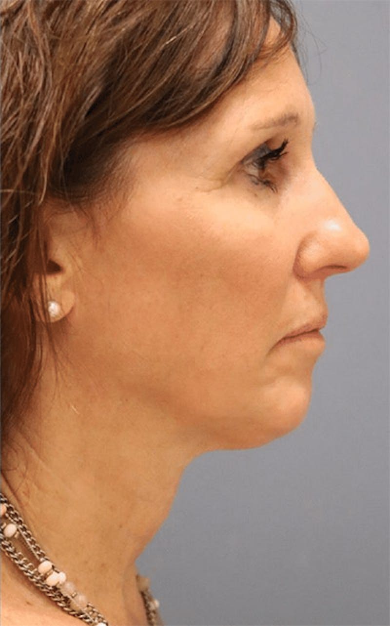 Pixel-8 RF Before & After Gallery - Patient 152226 - Image 2