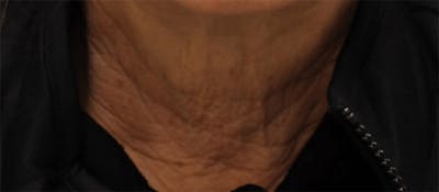 Pixel-8 RF Before & After Gallery - Patient 153577 - Image 1