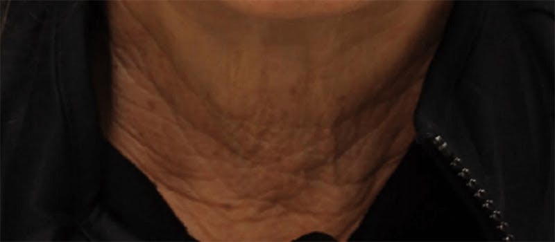 Pixel-8 RF Before & After Gallery - Patient 153577 - Image 1