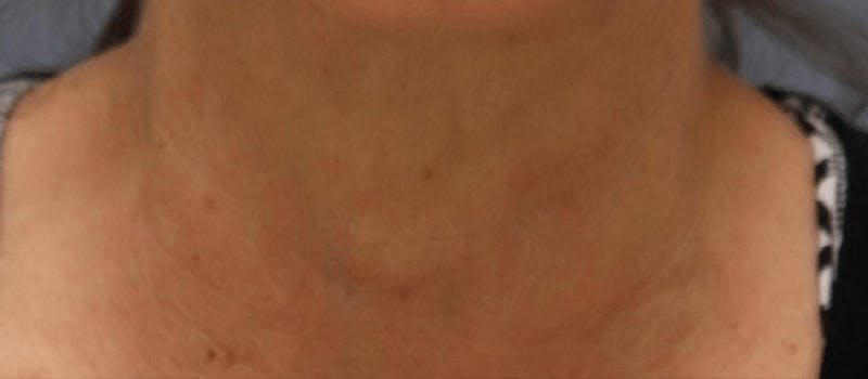Pixel-8 RF Before & After Gallery - Patient 153577 - Image 2