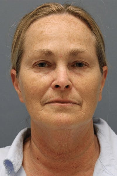 Pixel-8 RF Before & After Gallery - Patient 262895 - Image 1