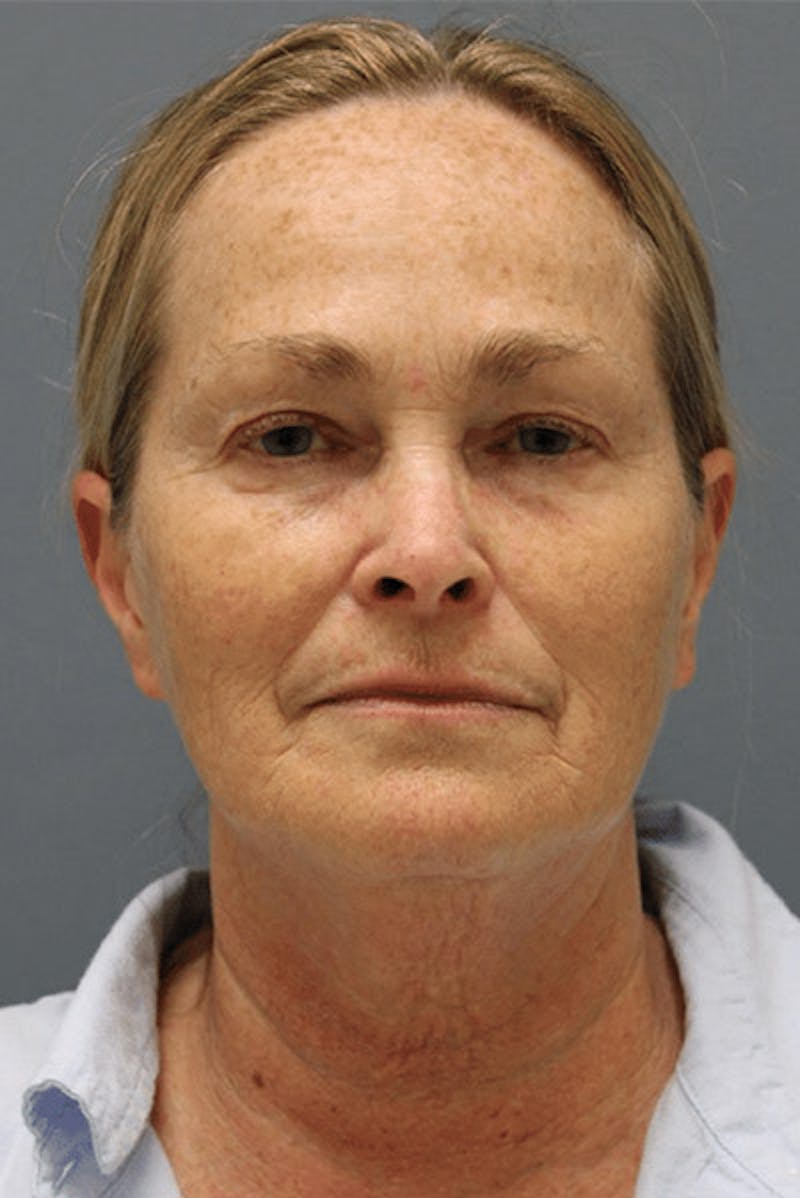 Pixel-8 RF Before & After Gallery - Patient 262895 - Image 1