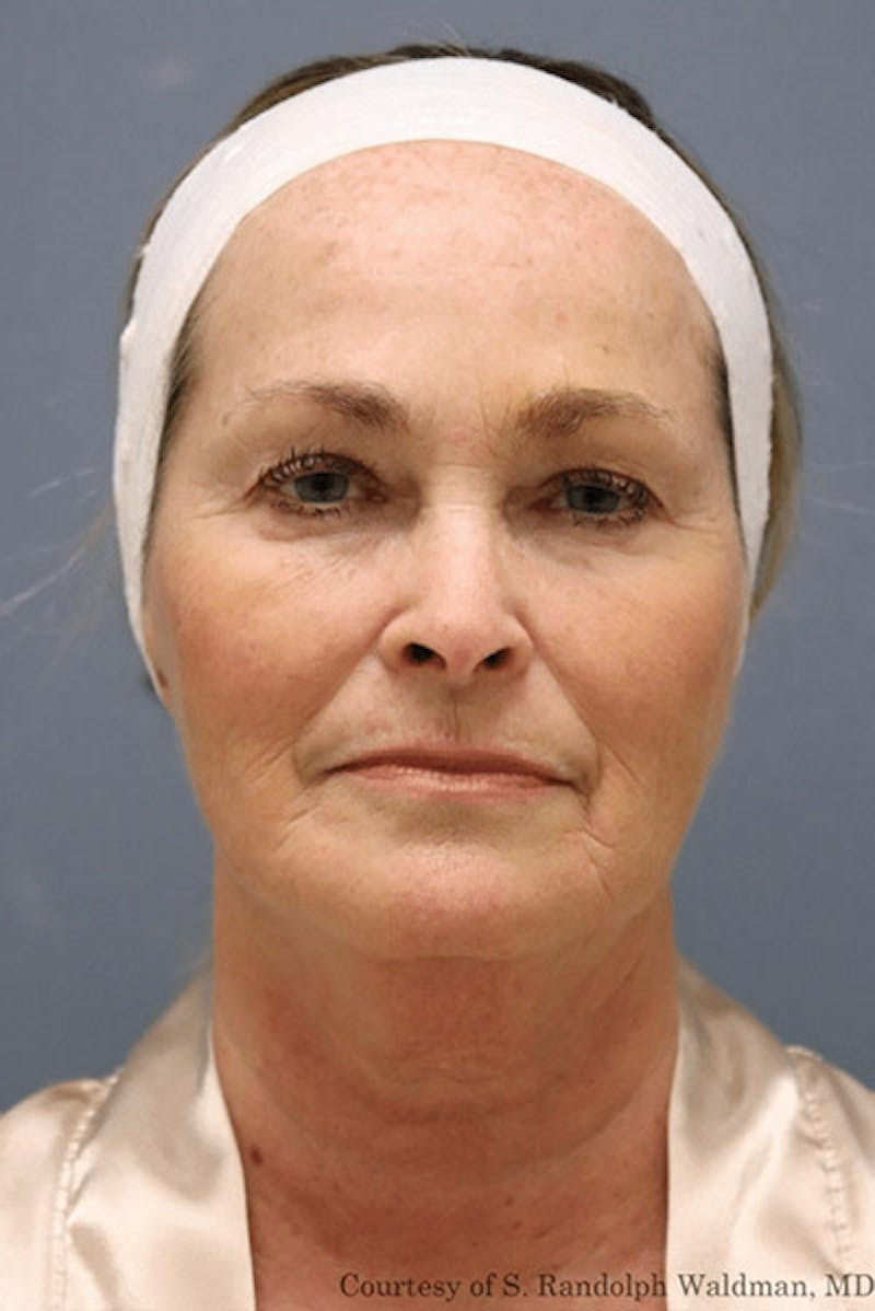 Pixel-8 RF Before & After Gallery - Patient 262895 - Image 2