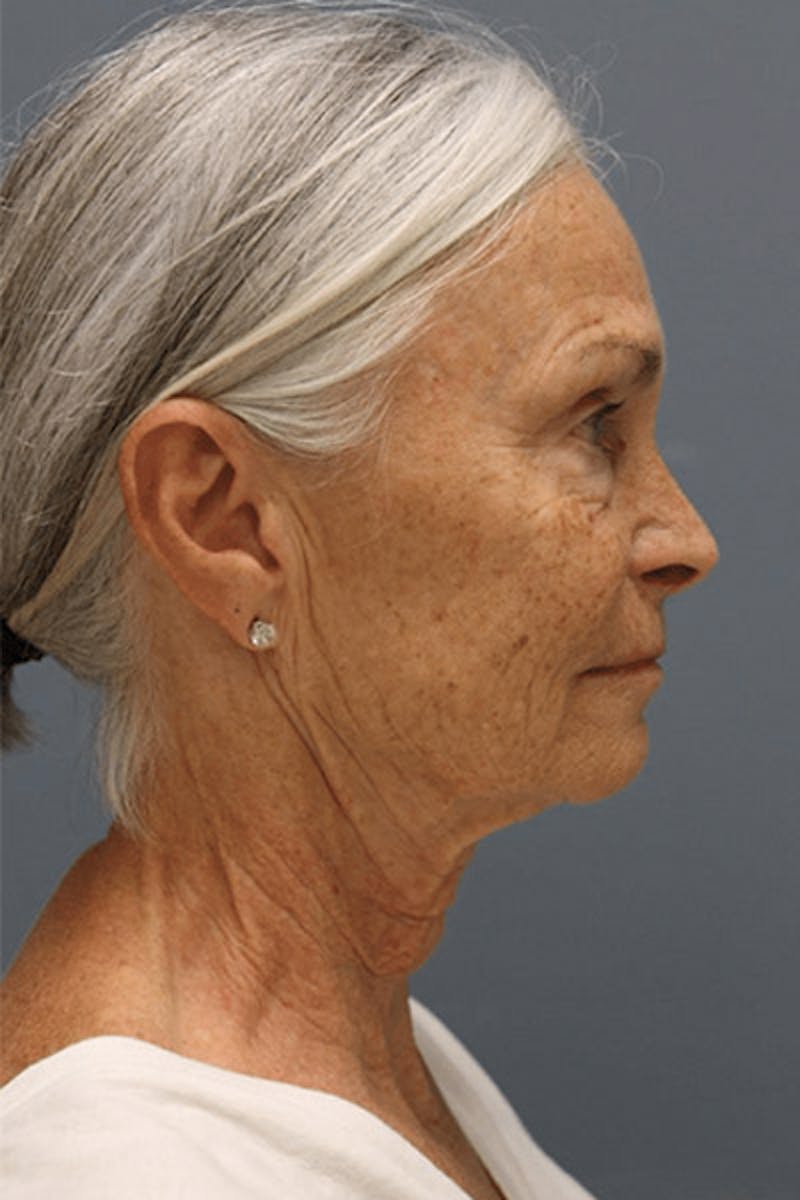 Pixel-8 RF Before & After Gallery - Patient 135361 - Image 1