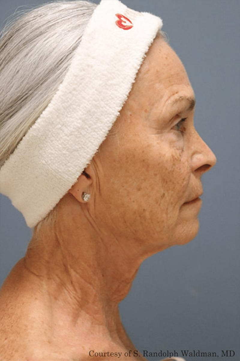 Pixel-8 RF Before & After Gallery - Patient 135361 - Image 2