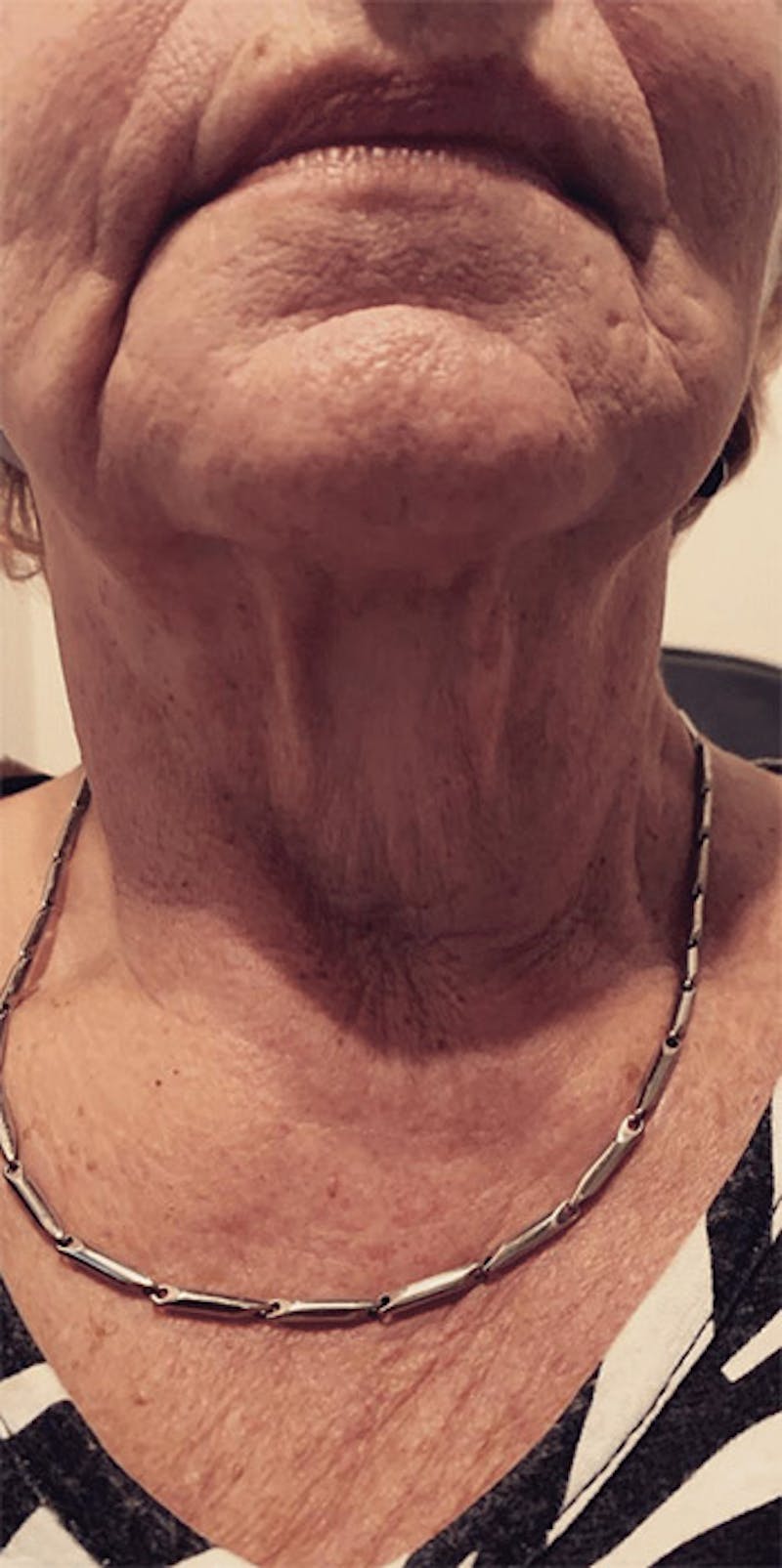 Pixel-8 RF Before & After Gallery - Patient 244352 - Image 1