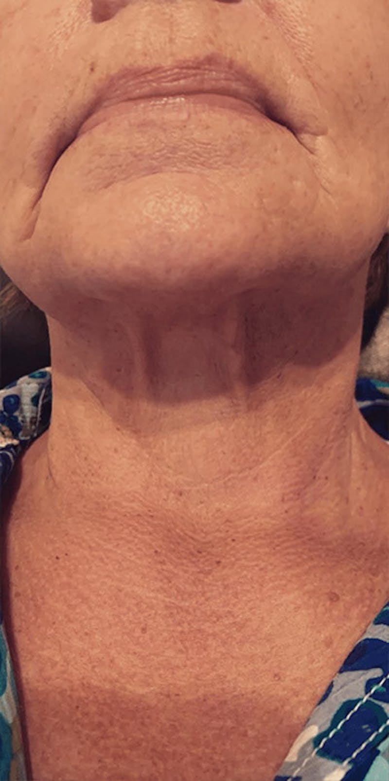 Pixel-8 RF Before & After Gallery - Patient 244352 - Image 2