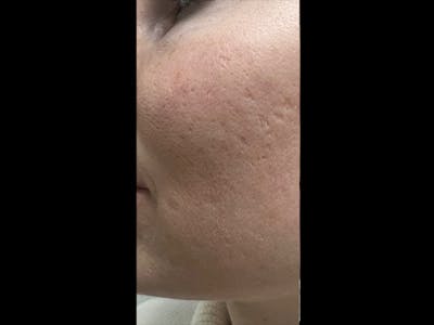 MiXto Laser Before & After Gallery - Patient 288913 - Image 1
