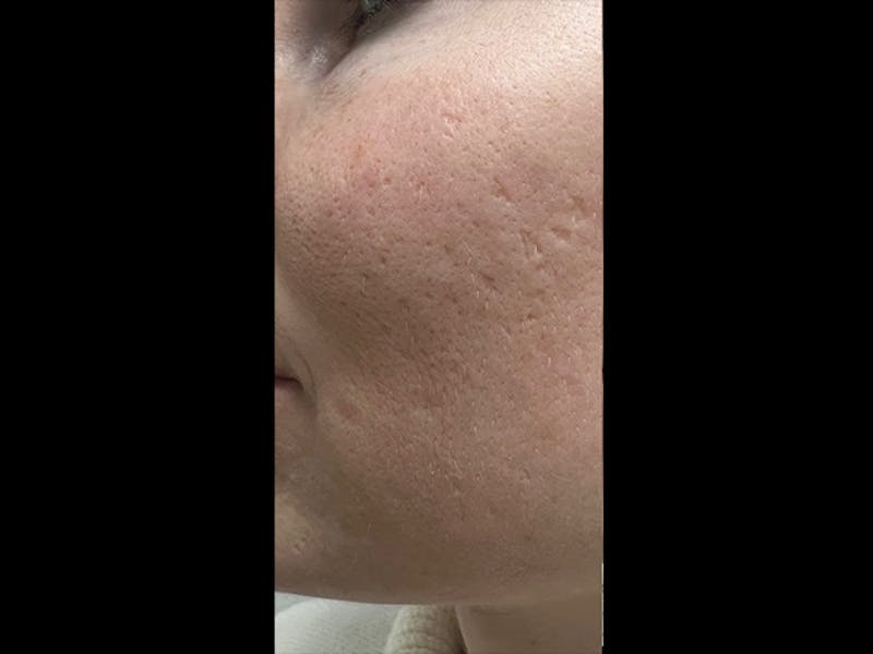 MiXto Laser Before & After Gallery - Patient 288913 - Image 1