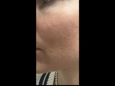 MiXto Laser Before & After Gallery - Patient 288913 - Image 2
