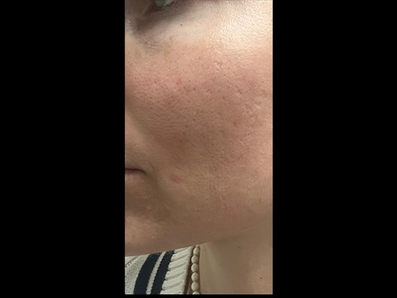 MiXto Laser Before & After Gallery - Patient 288913 - Image 2