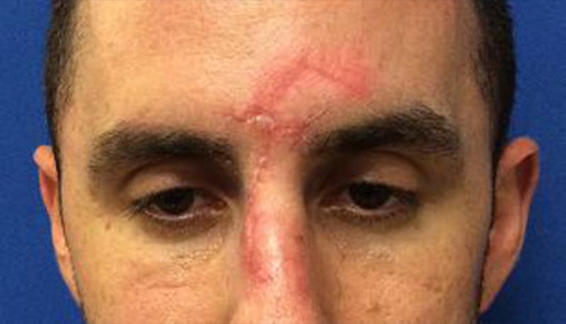 Scar Improvement Before & After Gallery - Patient 325268 - Image 1