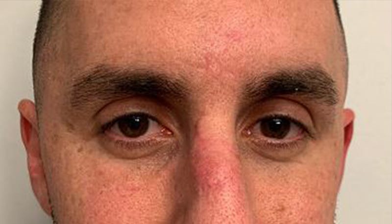 Scar Improvement Before & After Gallery - Patient 325268 - Image 2