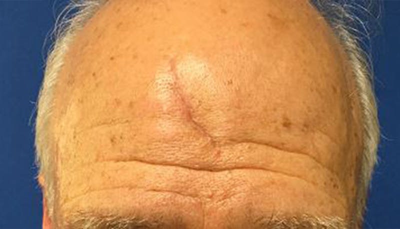 Scar Improvement Before & After Gallery - Patient 377251 - Image 1