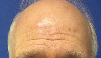 Scar Improvement Before & After Gallery - Patient 377251 - Image 2