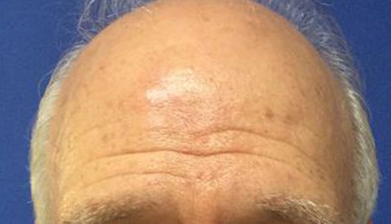 Scar Improvement Before & After Gallery - Patient 377251 - Image 2