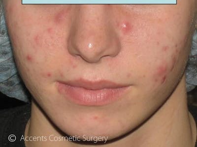 Skin Care Treatments Before & After Gallery - Patient 312742 - Image 1