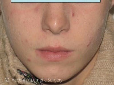 Skin Care Treatments Before & After Gallery - Patient 312742 - Image 2