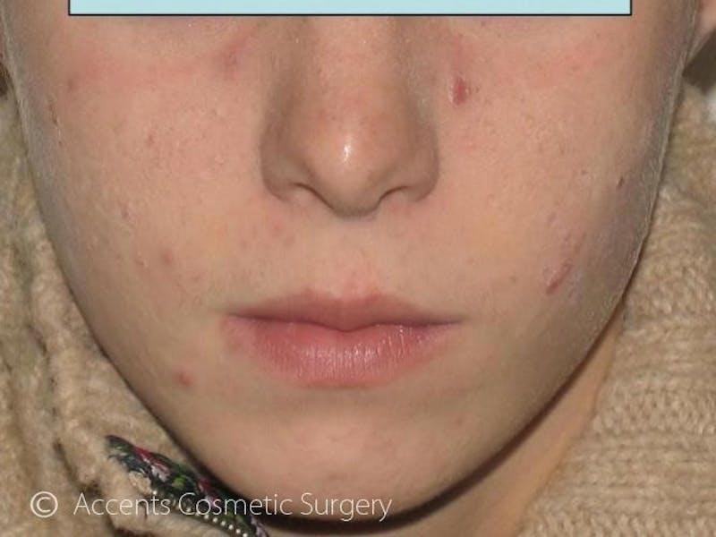 Skin Care Treatments Before & After Gallery - Patient 312742 - Image 2