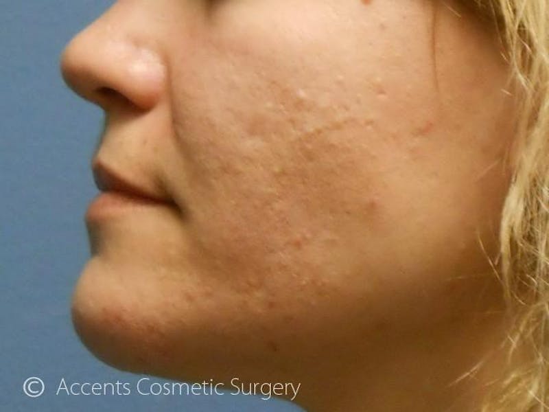 Skin Care Treatments Before & After Gallery - Patient 349140 - Image 1