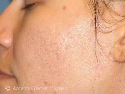 Skin Care Treatments Before & After Gallery - Patient 349140 - Image 2