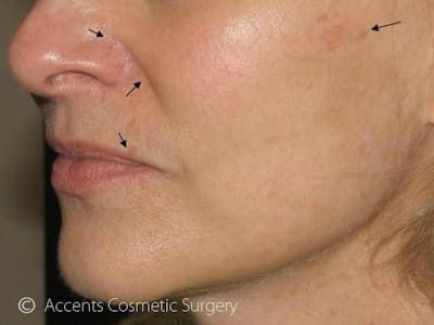 Skin Care Treatments Before & After Gallery - Patient 299560 - Image 1