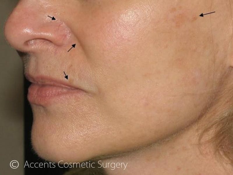 Skin Care Treatments Before & After Gallery - Patient 299560 - Image 1