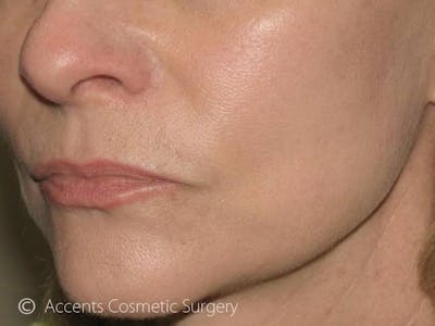 Skin Care Treatments Before & After Gallery - Patient 299560 - Image 2
