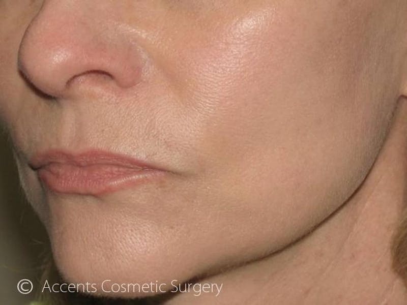 Skin Care Treatments Before & After Gallery - Patient 299560 - Image 2