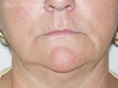 Thermage Face And Neck Before & After Gallery - Patient 193706 - Image 1