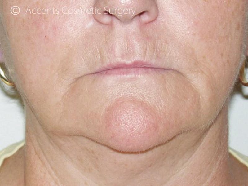 Thermage Face And Neck Before & After Gallery - Patient 193706 - Image 1