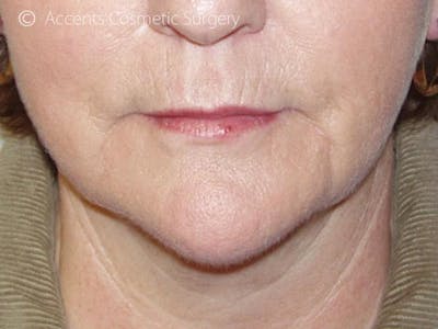 Thermage Face And Neck Before & After Gallery - Patient 193706 - Image 2