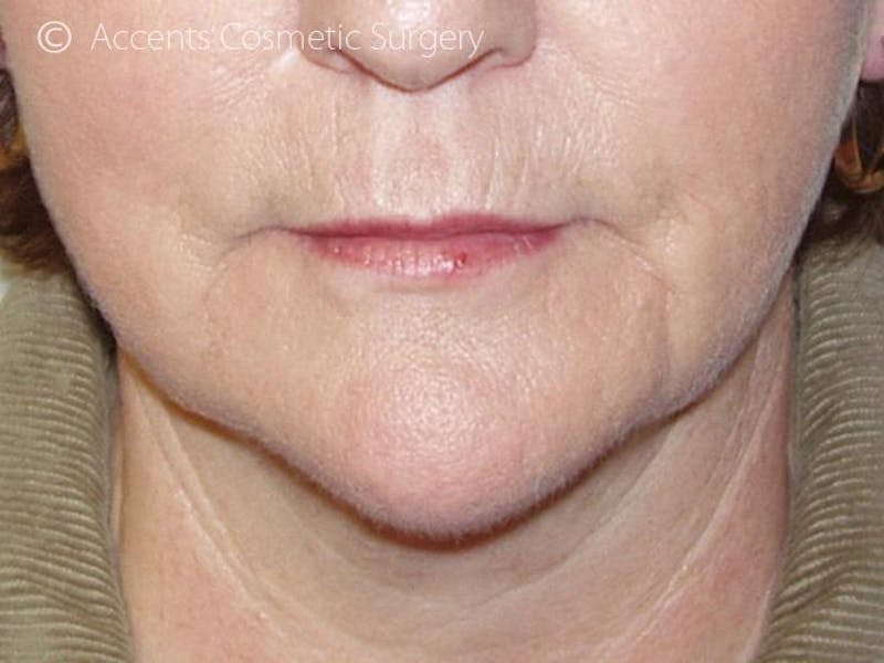Thermage Face And Neck Before & After Gallery - Patient 193706 - Image 2