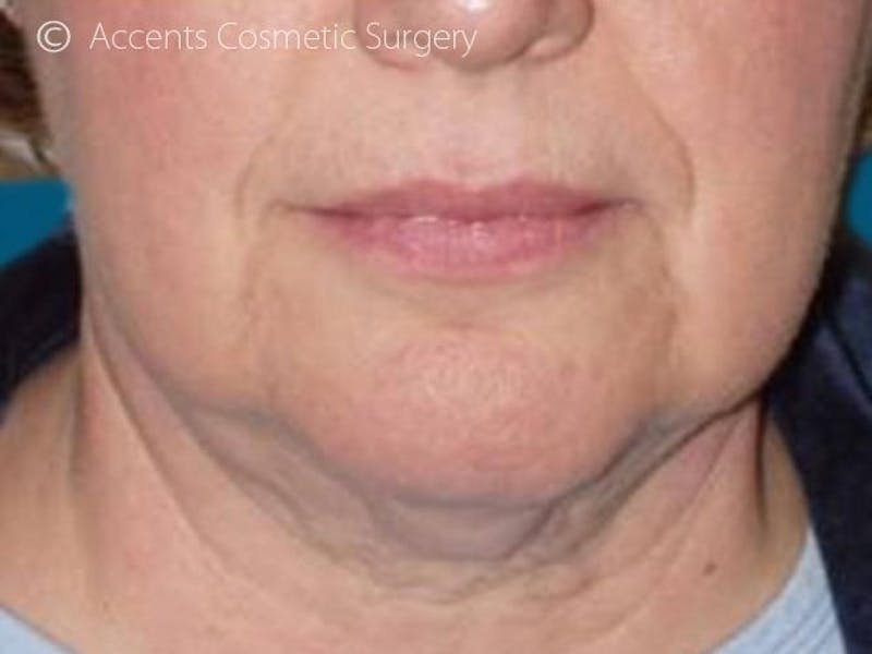 Thermage Face And Neck Before & After Gallery - Patient 340014 - Image 1