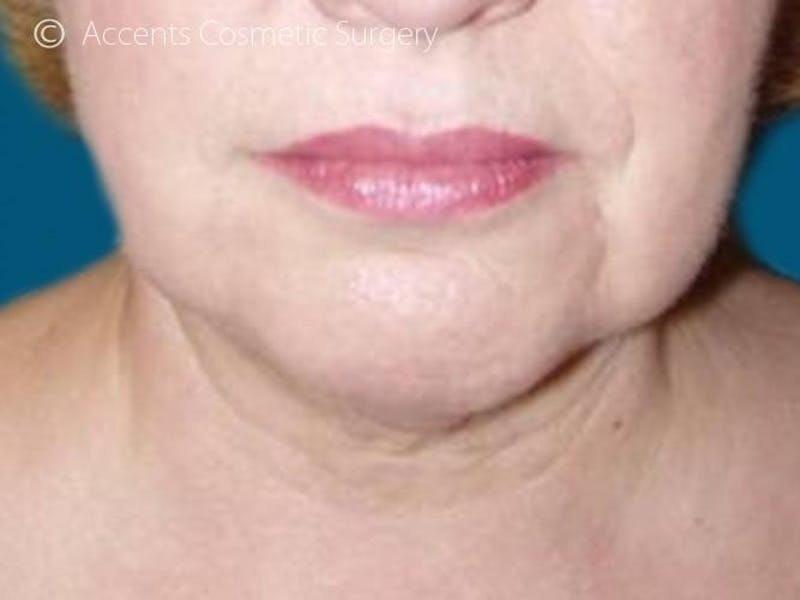 Thermage Face And Neck Before & After Gallery - Patient 340014 - Image 2