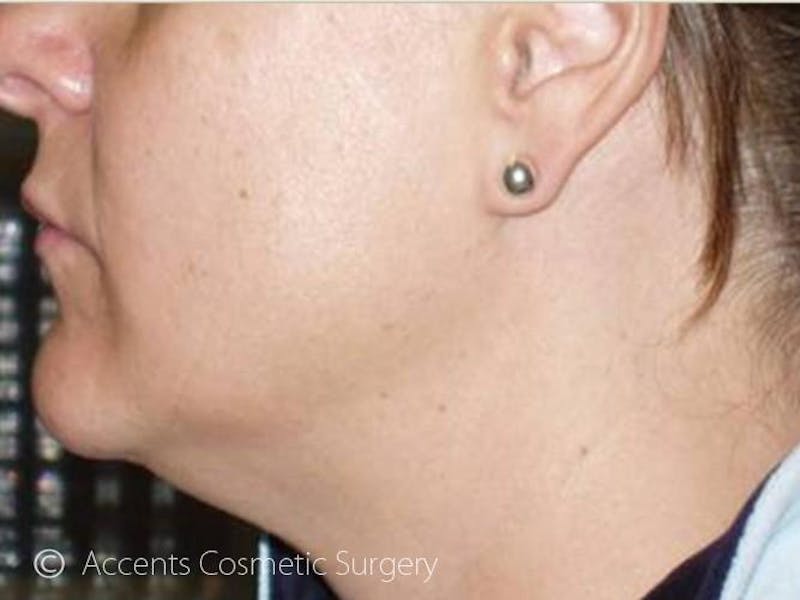 Thermage Face And Neck Before & After Gallery - Patient 272436 - Image 1